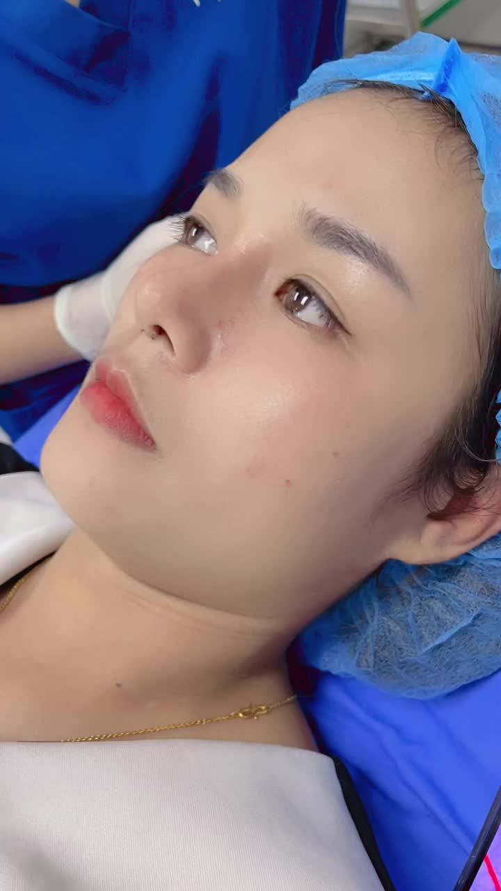Cắt chỉ nâng mũi 6D không đau sau 10 ngày phẫu thuật