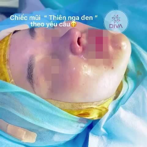 DÁNG MŨI CAO CHUẨN TỈ LỆ VÀNG