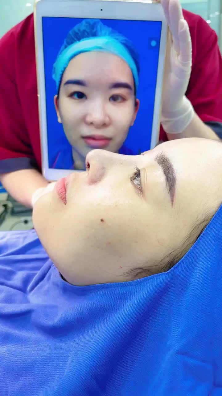 Mũi đẹp từng mm với nâng mũi 6D surgiform