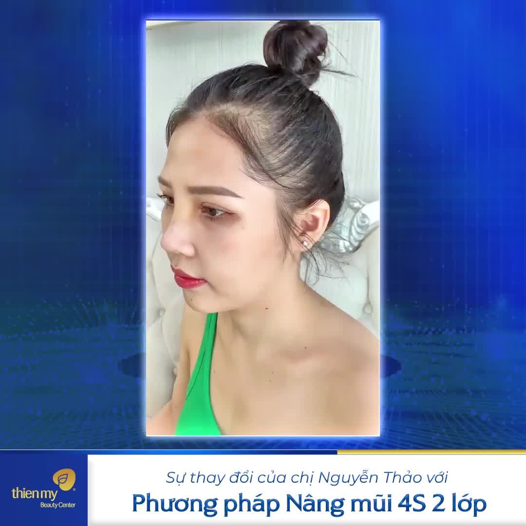 Sự thay đổi của chị Nguyễn Thảo với phương pháp nâng mũi 4S 2 lớp