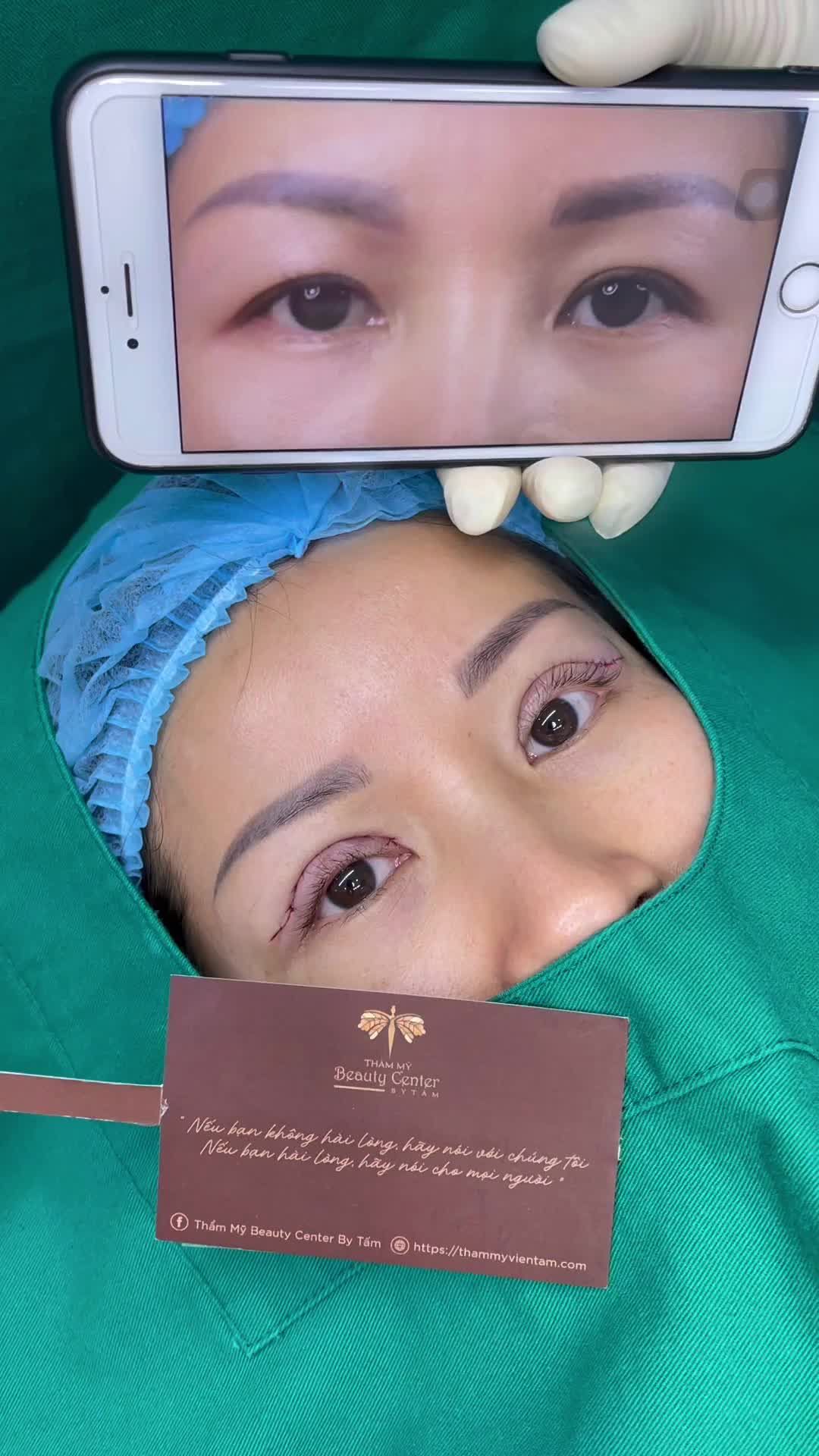 Thay đổi rõ rệt ngay sau khi Cắt mí Line Mini tại TMV Tấm. Mọi người cùng so sánh sự khác biệt nhé!