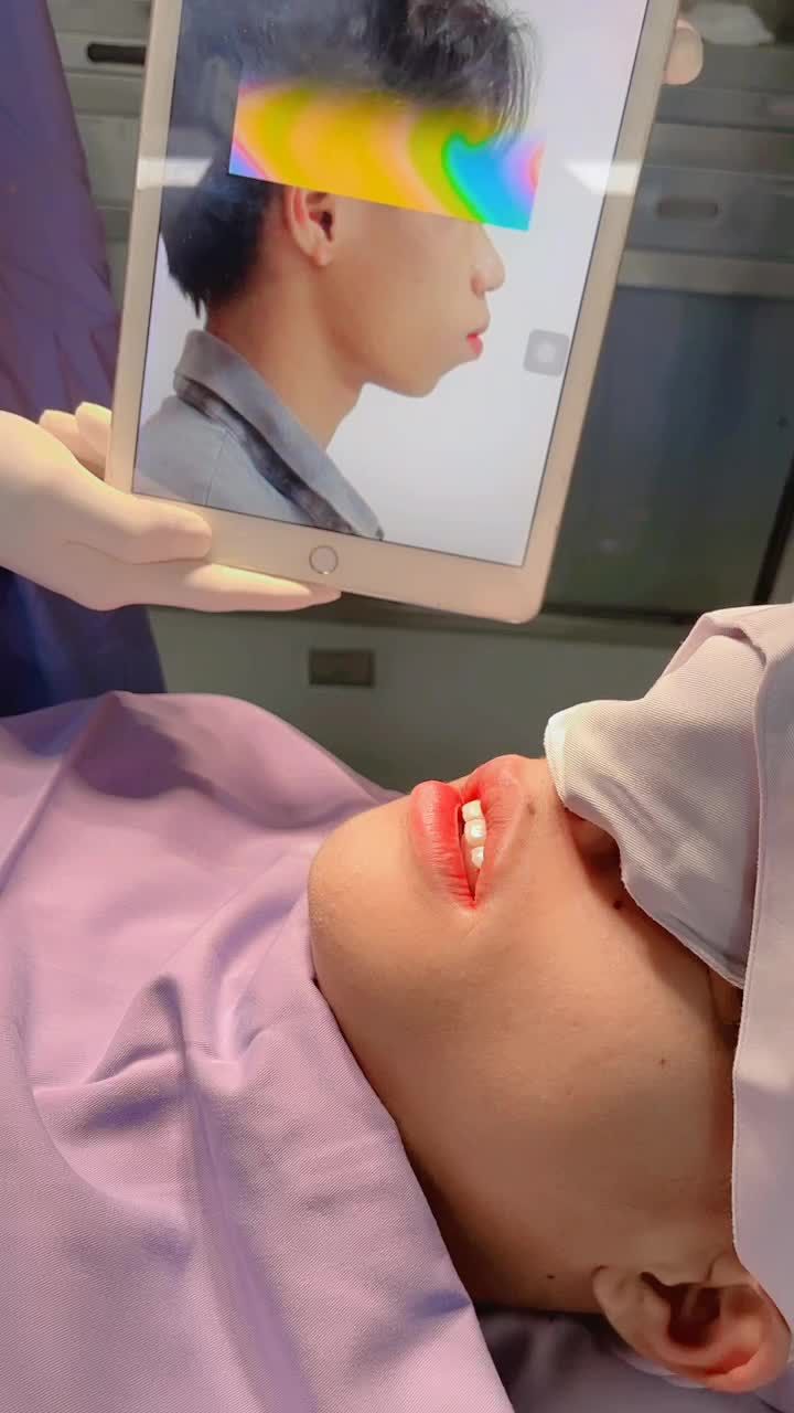 Lột xác ngoạn mục - Hàm hô quá phát biến với công nghệ Chỉnh hàm 3D tại Kangnam Sài Gòn