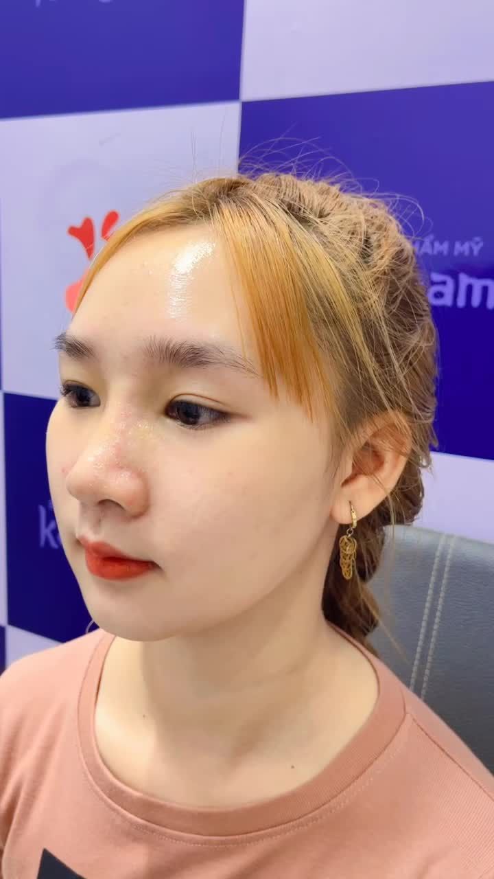 Trẻ trung và xinh xắn hơn với công nghệ Nâng mũi cấu trúc 4D tại Kangnam