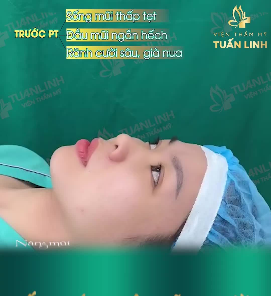 NÂNG MŨI + ĐỘN RÃNH CƯỜI - BÍ KÍP HACK TUỔI HIỆU QUẢ DÀI LÂU