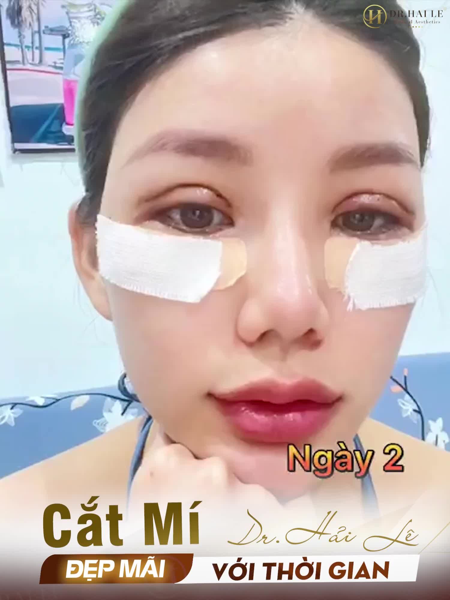 Review từ A-Z hành trình mí mắt trên dưới sau 3 tháng Cắt mí tại Dr.Hải Lê cơ sở HCM