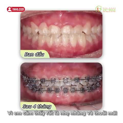 BẤT NGỜ KHI NIỀNG RĂNG MÓM NHẸ NHÀNG, THOẢI MÁI