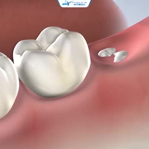BIẾN CHỨNG NGUY HIỂM CỦA RĂNG KHÔN MỌC LỆCH