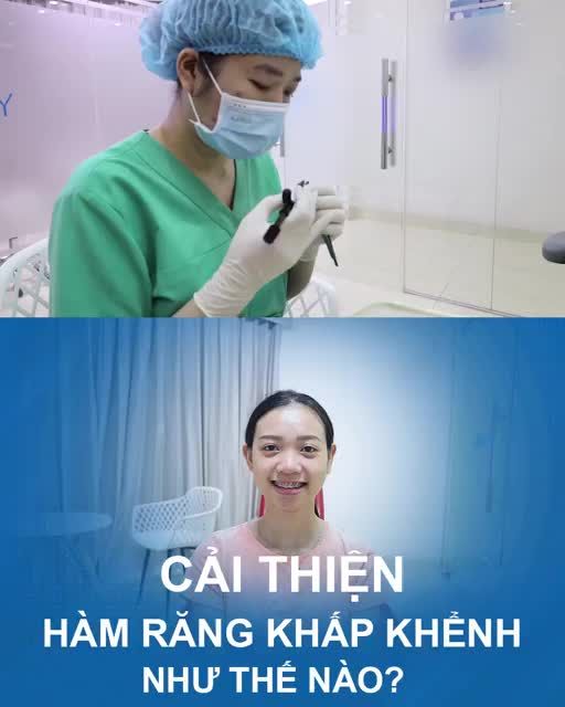 Cải thiện răng khấp khểnh như thế nào