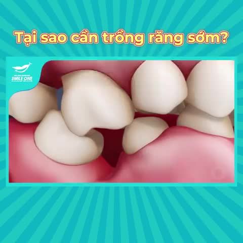 CẤY 1 TRỤ IMPLANT TẶNG 1 RĂNG SỨ CAO CẤP TRỊ GIÁ LÊN TỚI 5,5 TRIỆU ĐỒNG