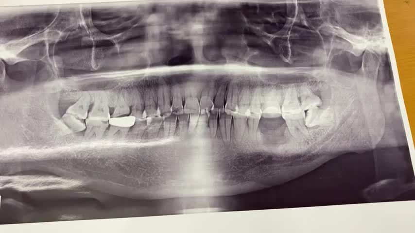Cấy ghép Implant răng 36 cho chú Tâm tại Nha Khoa Thuỳ Anh.