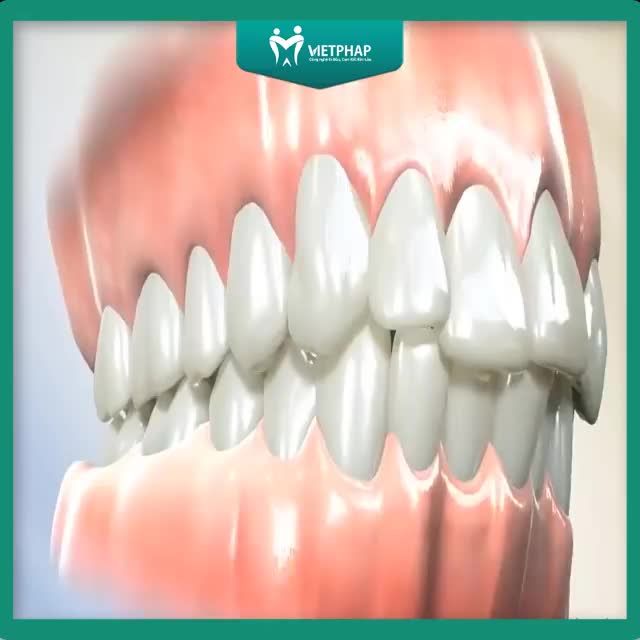 CÓ NÊN NHỔ RĂNG SỐ 4 KHI NIỀNG RĂNG HAY KHÔNG