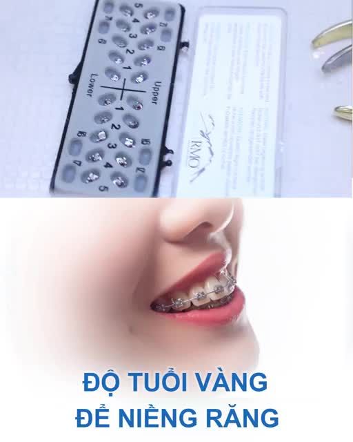 Độ tuổi vàng để niềng răng