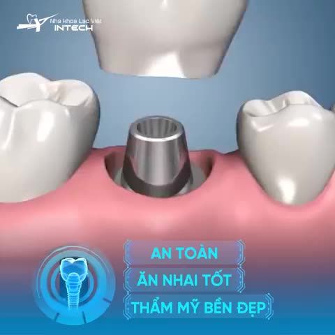 GIÁ TRỒNG RĂNG IMPLANT LÀ BAO NHIÊU