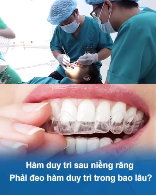 HÀM DUY TRÌ NIỀNG RĂNG LÀ GÌ - NÊN ĐEO TRONG BAO LÂU
