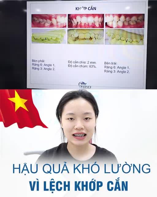 HẬU QUẢ KHÓ LƯỜNG VÌ LỆCH KHỚP CẮN