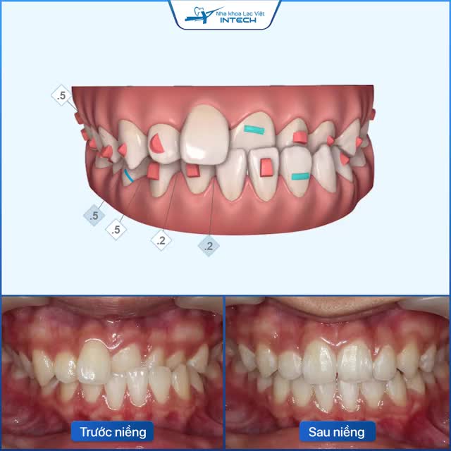 INVISALIGN KHẮC PHỤC HOÀN TOÀN KHỚP CẮN CHÉO