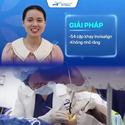 Invisalign thành công tại Nha khoa Lạc Việt Intech