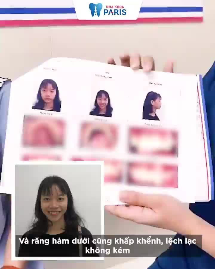 Khách hàng Phương niềng răng tại nha khoa Paris Hà Nội