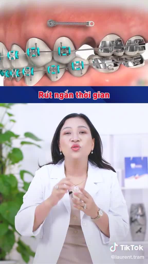 Khi nào thì cắm Minivis hỗ trợ niềng răng