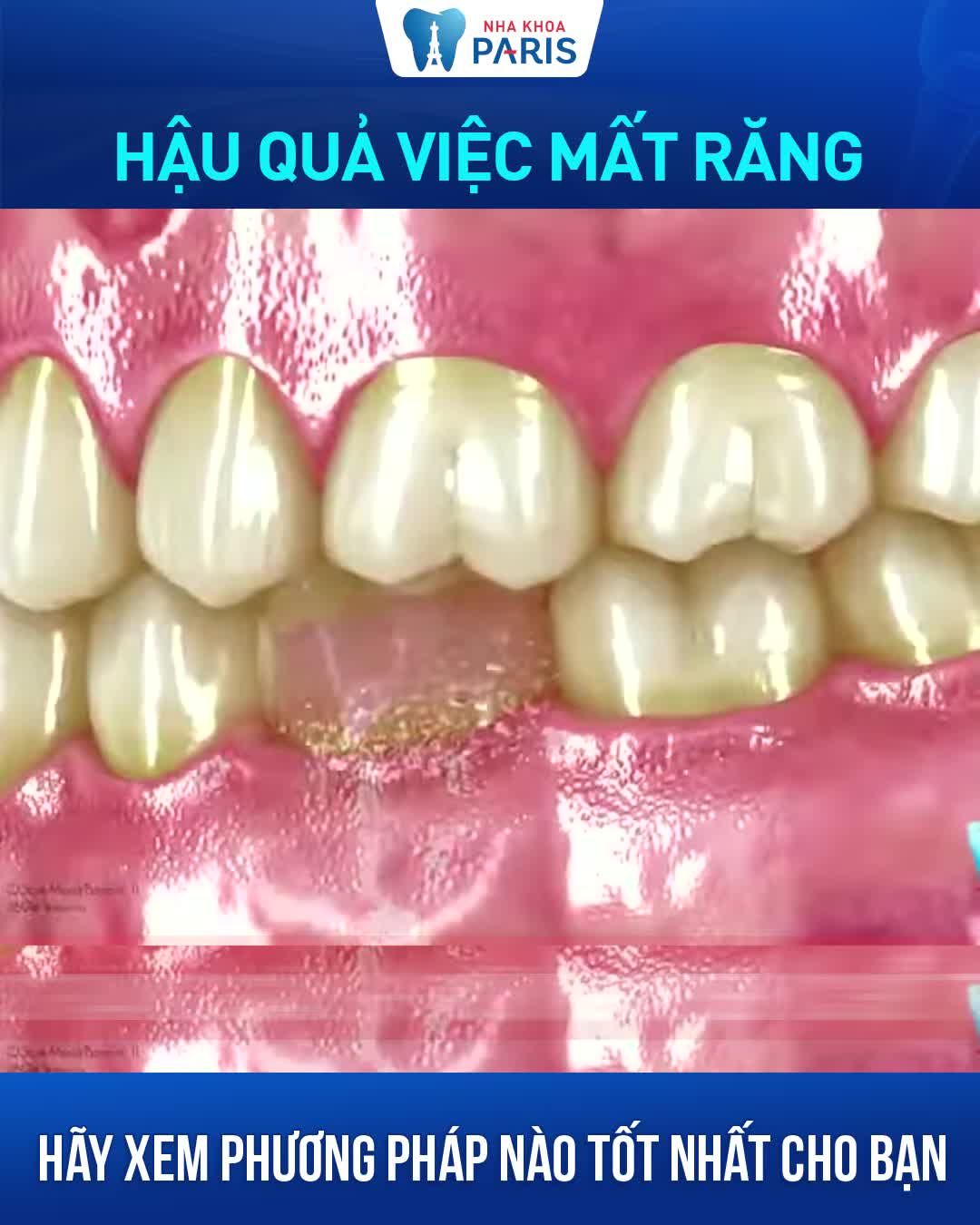 LÀM SAO KHÔI PHỤC RĂNG MẤT TRỌN ĐỜI