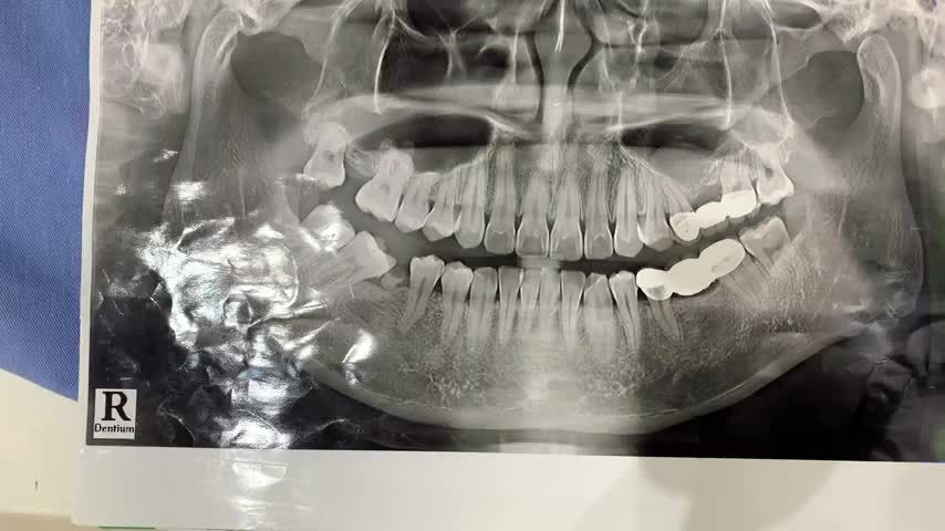 Lắp răng implant khôi phục lại chức năng ăn nhai răng 46 bị mất cho anh Quang tại Nha Khoa Thuỳ Anh.