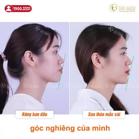 LỘT XÁC NỤ CƯỜI SAU HÀNH TRÌNH 2 NĂM NIỀNG RĂNG HÔ