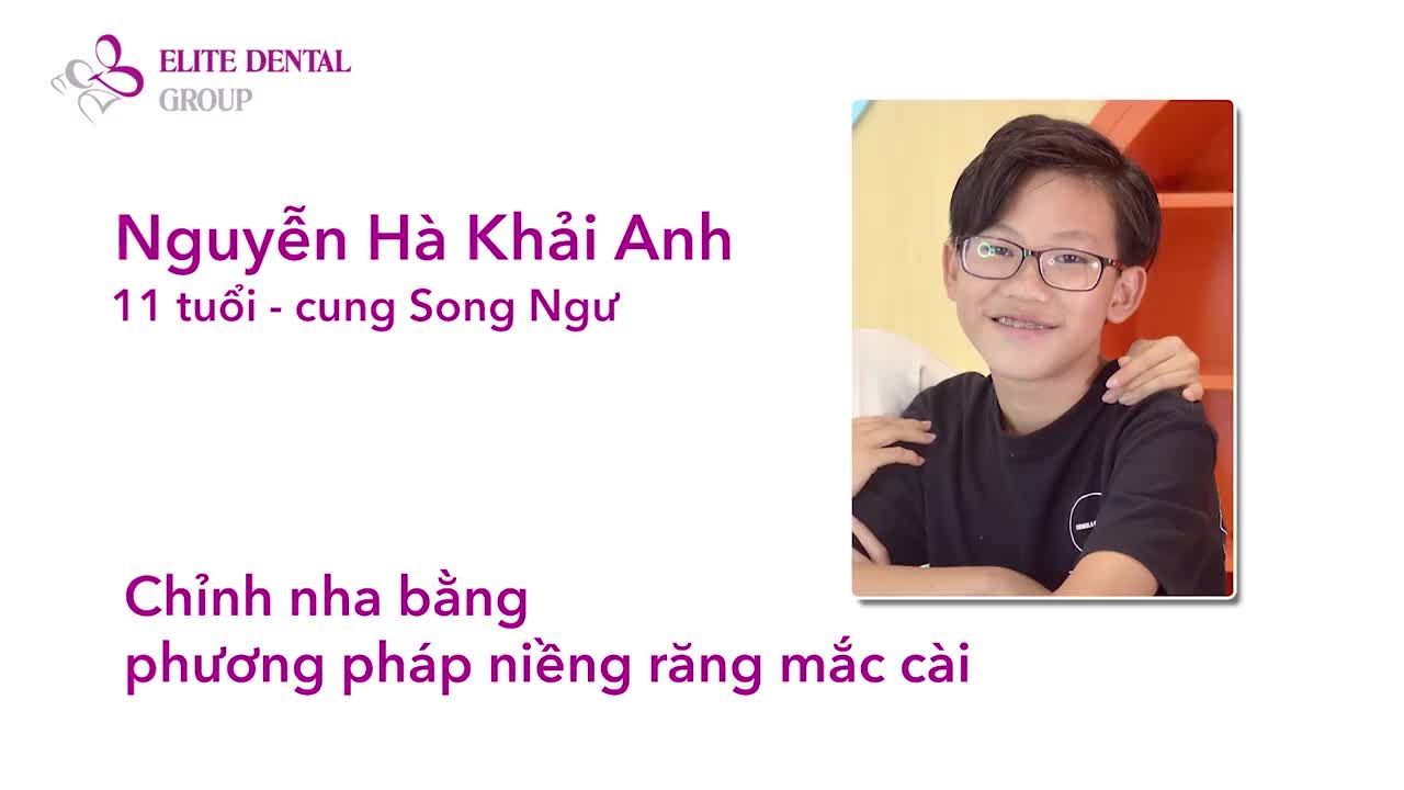 Nhổ mầm răng khôn mọc sớm khi con đang chỉnh nha có đáng lo