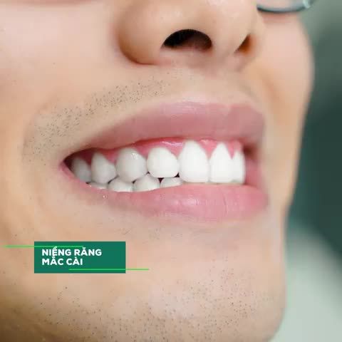 NIỀNG RĂNG CHỈNH NHA - HÓA SOÁI CA CHỈ SAU THỜI GIAN NGẮN