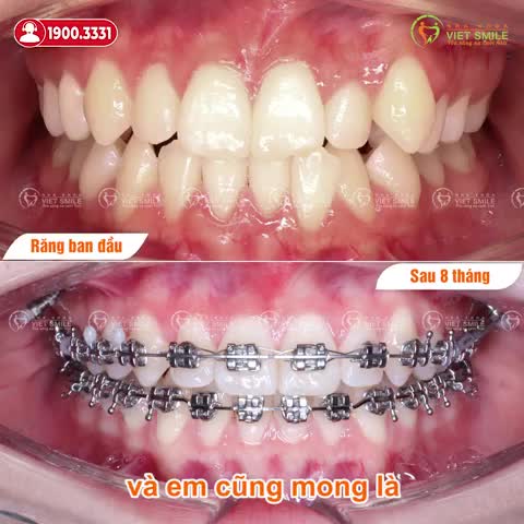 NỤ CƯỜI, KHỚP CẮN THAY ĐỔI RÕ RỆT SAU 8 THÁNG NIỀNG RĂNG