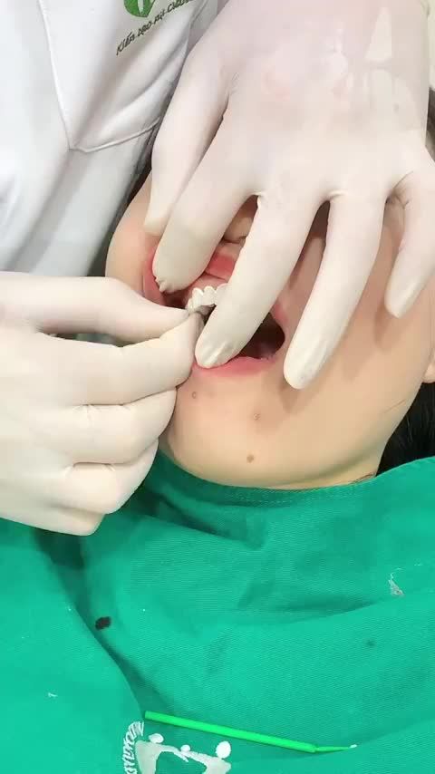 QUÁ TRÌNH LẮP 20 VENEER SỨ NGỌC TRAI CAO CẤP