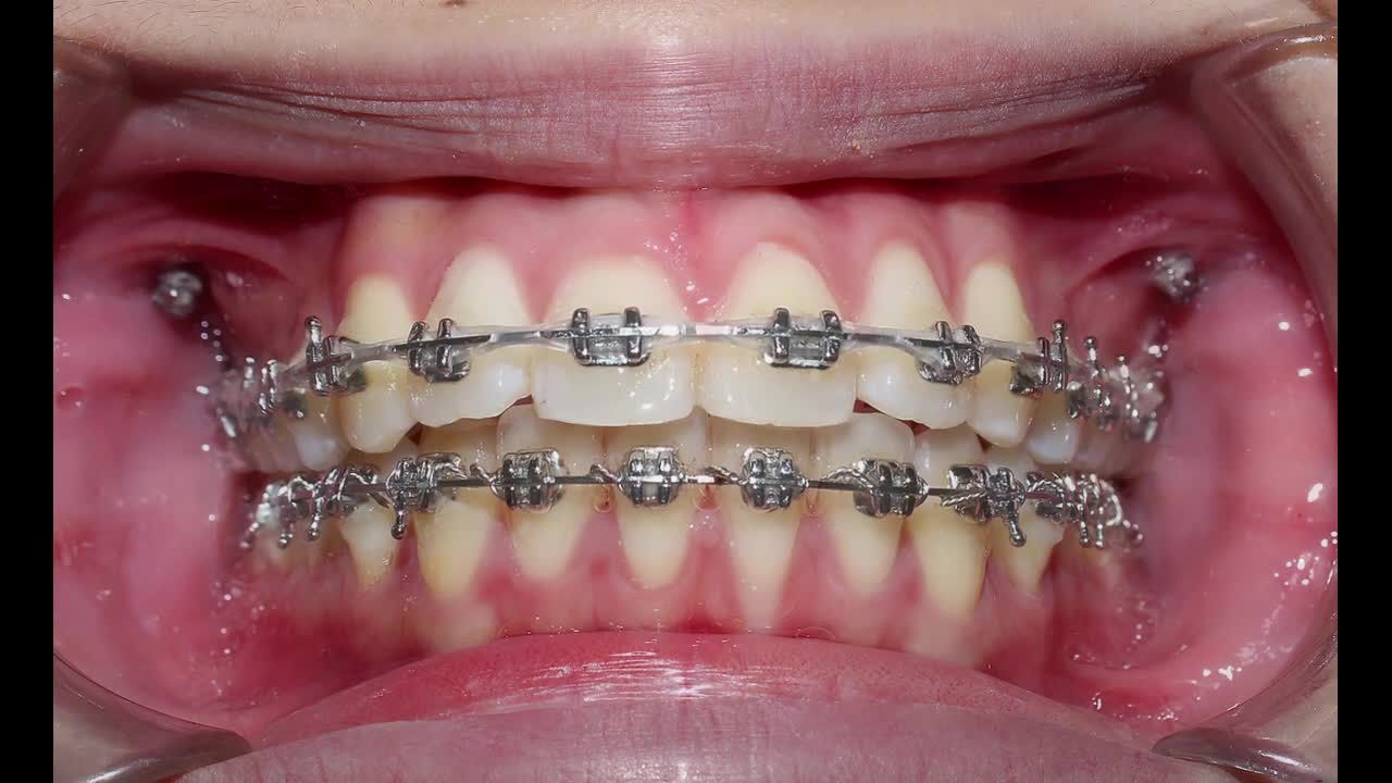 RĂNG MỌC LỆCH - KHÔNG ĐỀU