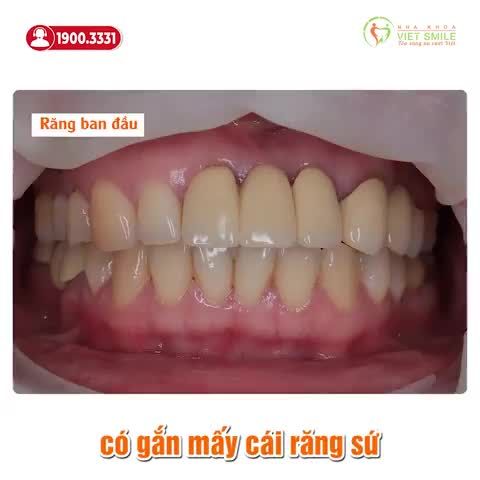 SỞ HỮU RĂNG ĐẸP, NỤ CƯỜI NHƯ Ý CHỈ SAU 10 NGÀY