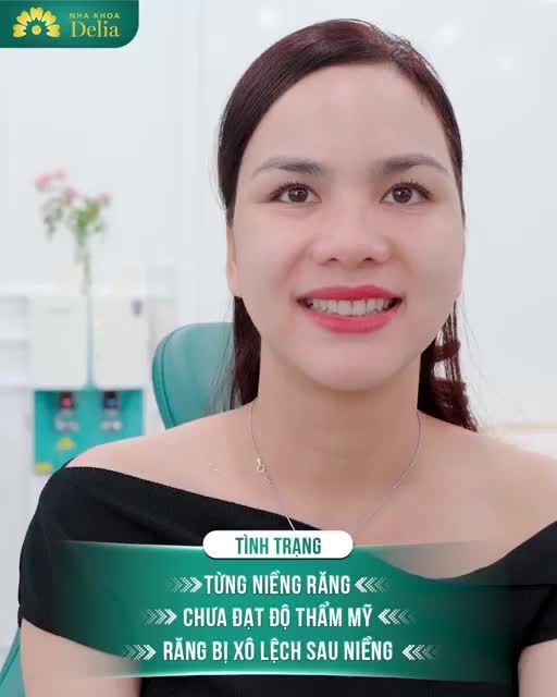 Thẩm mỹ 16 răng sứ Emax - Nụ cười mới trọn niềm vui