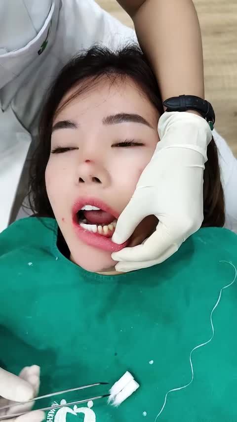 THẨM MỸ 20 RĂNG SỨ ORODENT CHO NỮ KHÁCH HÀNG XINH ĐẸP