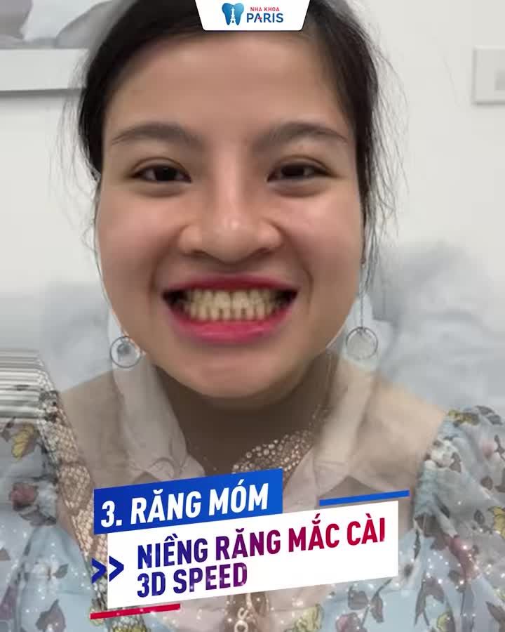 TOP 5 Case niềng răng thay đổi ngoạn mục
