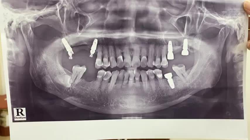 Trồng răng Implant R46 cho bác khách hàng tại Nha Khoa Thuỳ Anh.