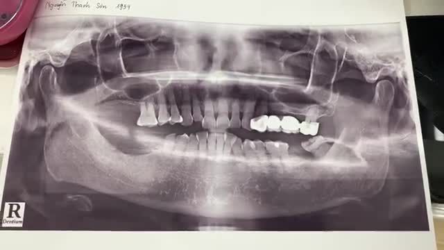 Trồng răng số 46 và 47 cho bác khách hàng tại Nha Khoa Thuỳ Anh.