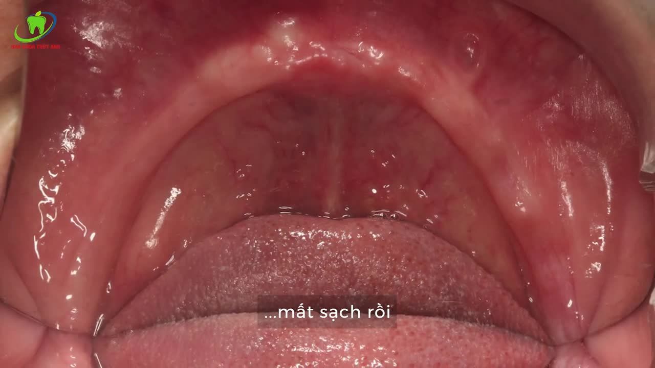 TRỒNG RĂNG TOÀN HÀM ALL ON 4 - RĂNG CHẮC KHỎE - THẨM MỸ TỐI ĐA