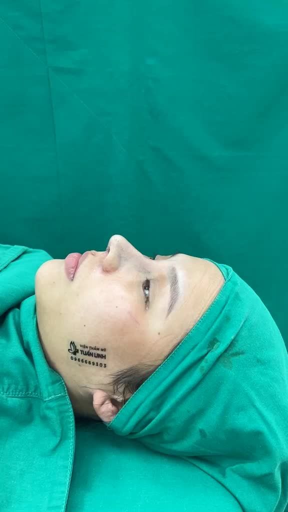 NÂNG MŨI CẤU TRÚC SỤN MỸ CHO BẠN GÁI THÍCH CAO TÂY