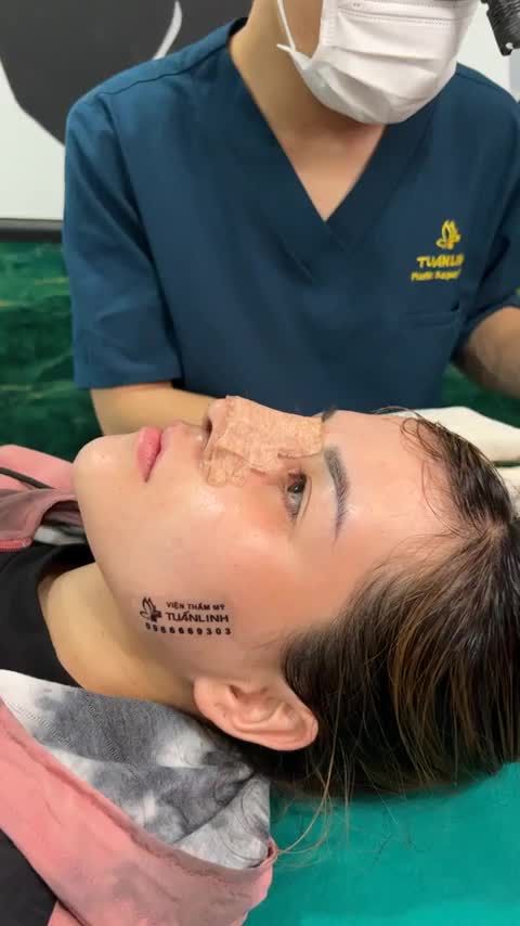 PHOM MŨI TỰ NHIÊN SAU 10 NGÀY CẮT CHỈ