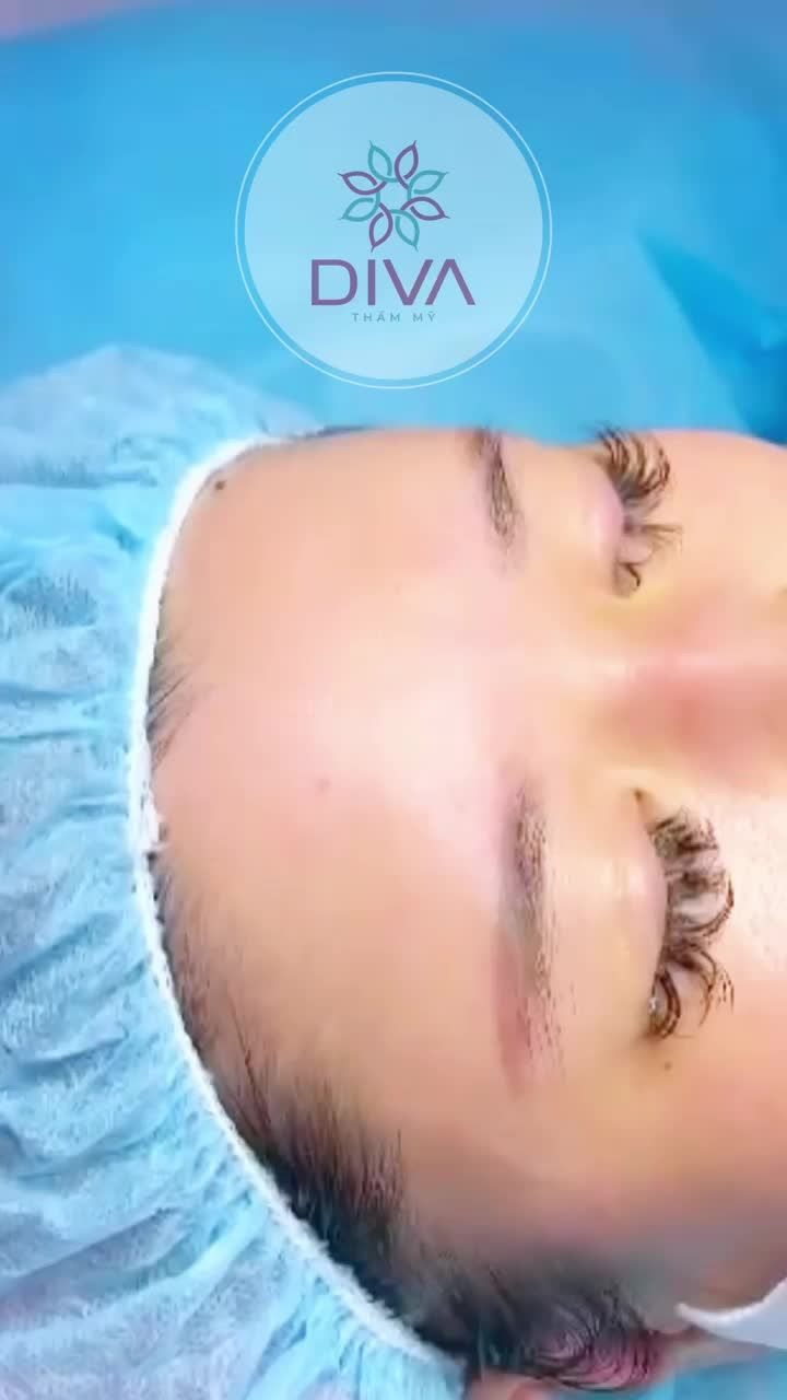 CẢI THIỆN VÙNG TRÁN HÓP NGAY SAU THỰC HIỆN