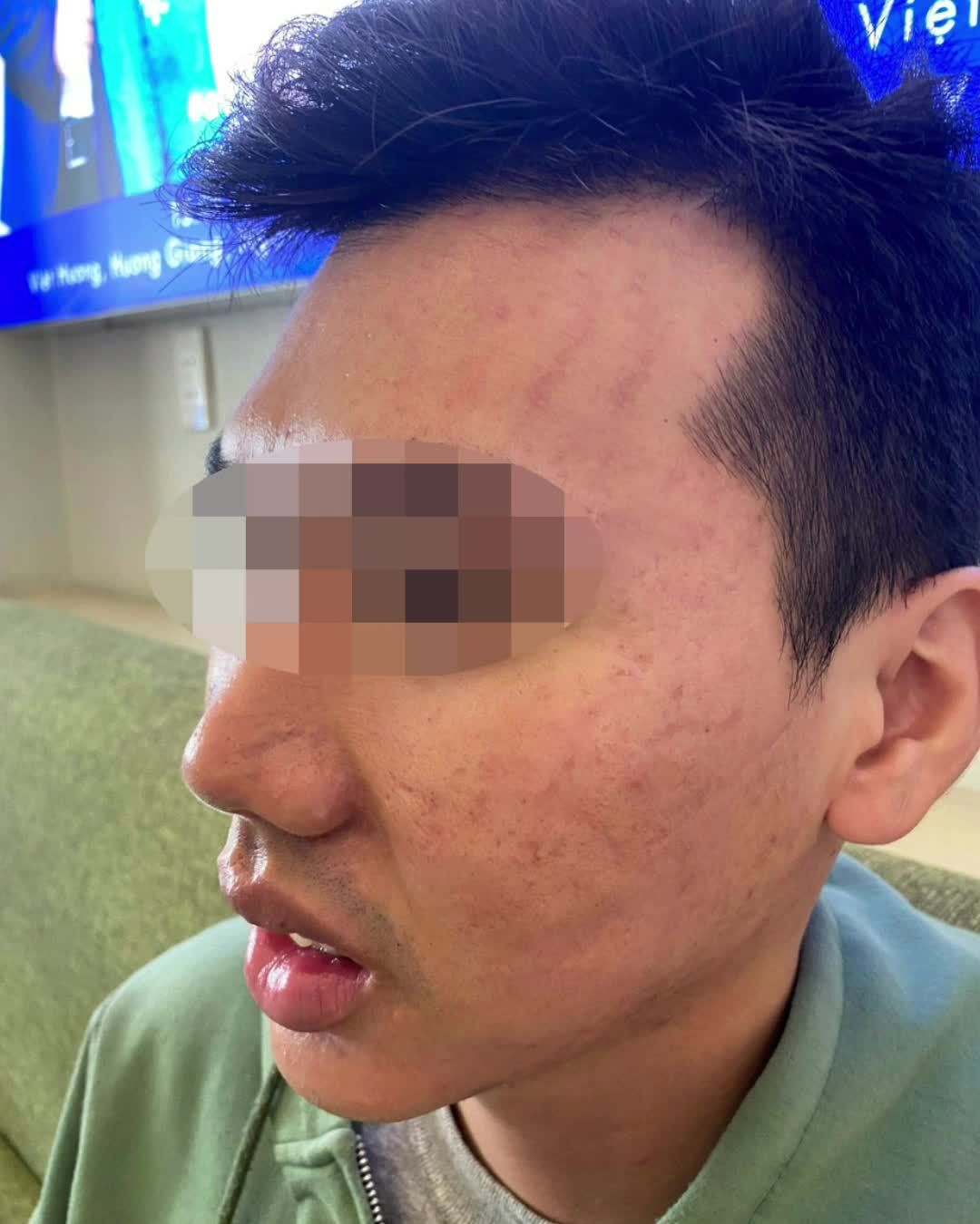 MẶT THỦNG LỖ chi chít vì SẸO RỖ 10 NĂM bỗng cải thiện HƠN 90% chỉ sau 3 lần điều trị ở JW