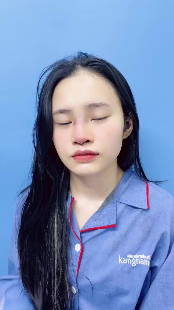 Vừa nâng mũi và làm môi tim xong kết quả để mê li như thế này rồi! Các chị em xem ngay kết quả này nhé