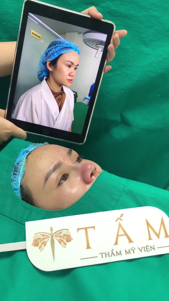 Kết quả ngay sau nâng mũi Surgiform + bọc đầu mũi sụn Megaderm cho khách hàng Thuỳ Linh