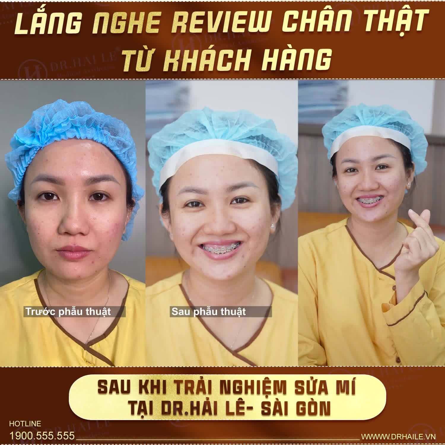 Trước khi cắt em sợ ĐAU, BẦM, SƯNG, KHÔNG ĐẸP