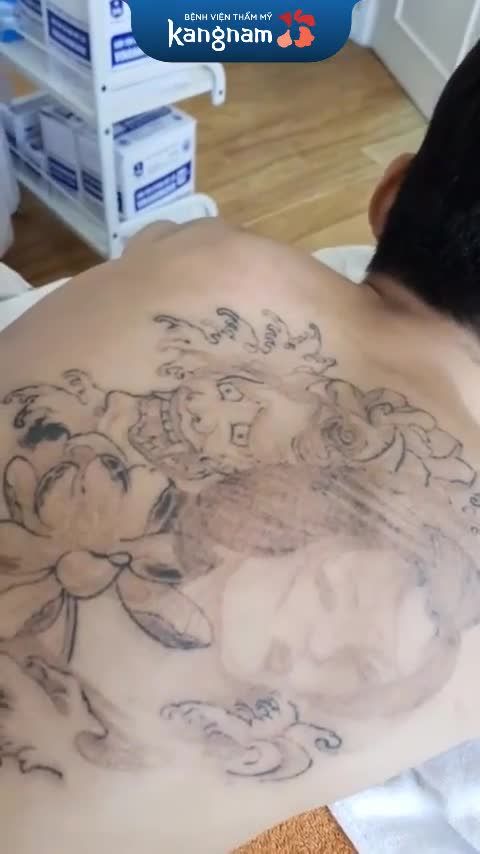 U là trời - Kết quả xóa xăm sau 2 lần đây rồi!!!!