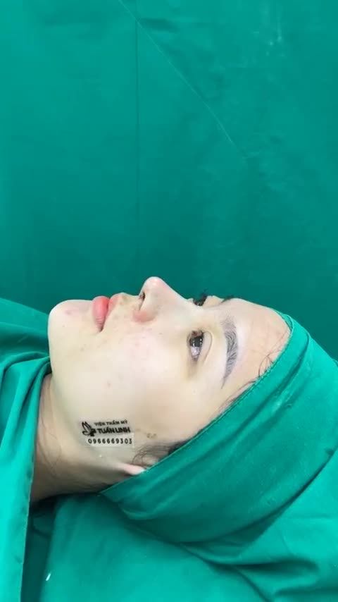 Nâng mũi cấu trúc dáng mũi thanh thoát tự nhiên mềm mại