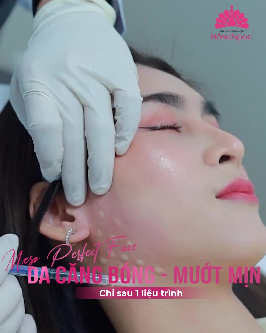 CẤP CỨU LÀN DA XỈN MÀU, XẠM NÁM VỚI MESO PERFECT FACE