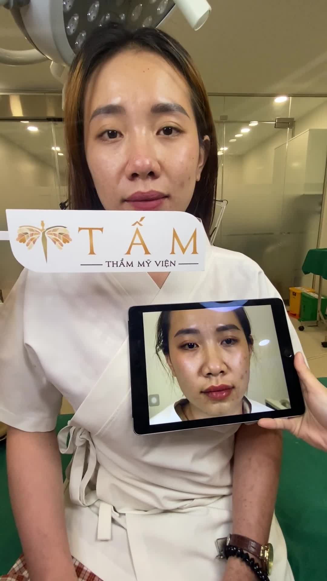 Cùng nhìn ngắm dáng mũi nàng khách đã thực hiện thu gọn cánh mũi tại TMV Tấm sau 7 ngày nhé!