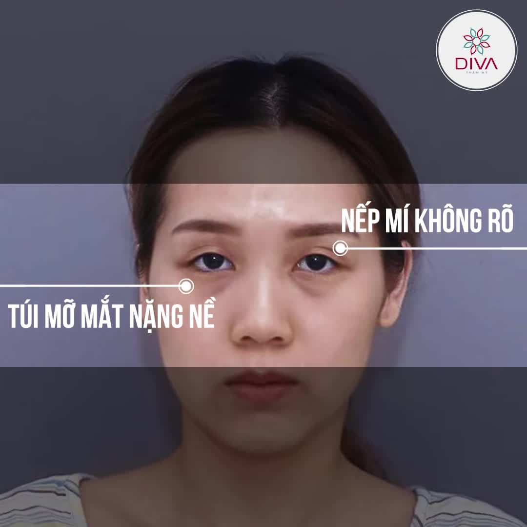 KẾT QUẢ THẨM MỸ NHẤN MÍ + LẤY TÚI MỠ MÍ DƯỚI